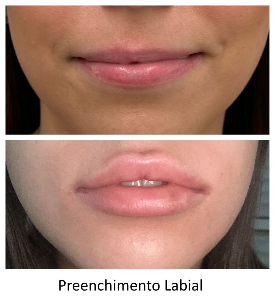 Resultado de tratamento estético — Dra. Priscilla Della Lucia