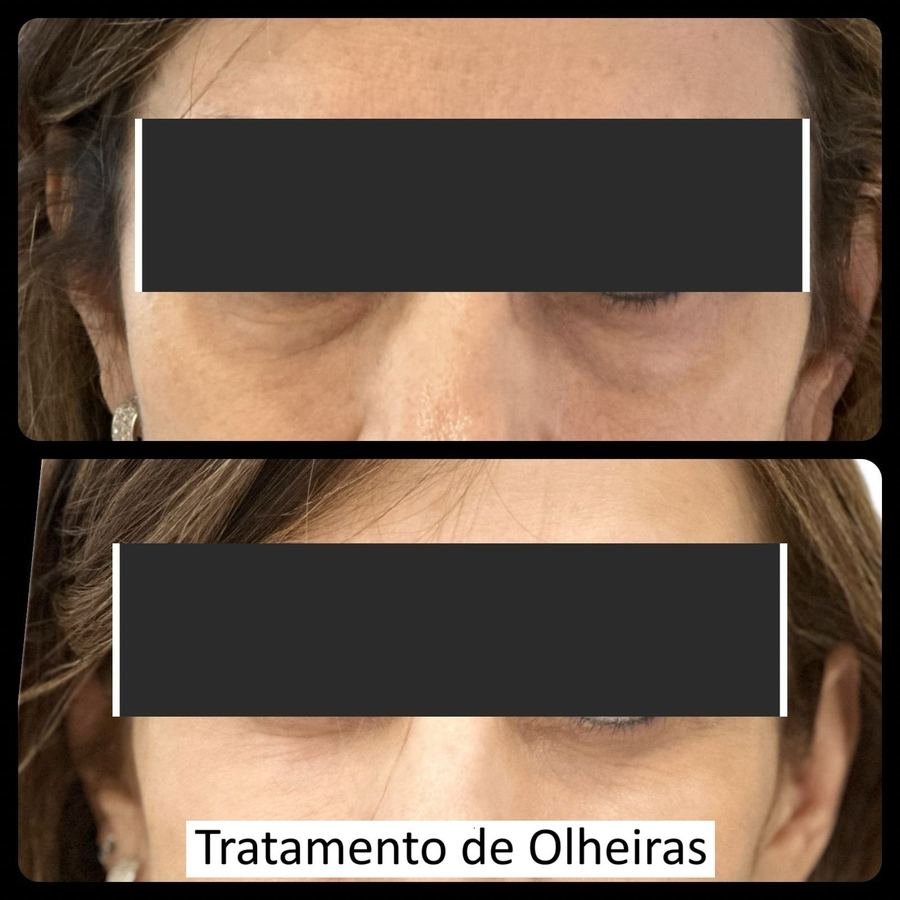 Resultado de tratamento estético — Dra. Priscilla Della Lucia
