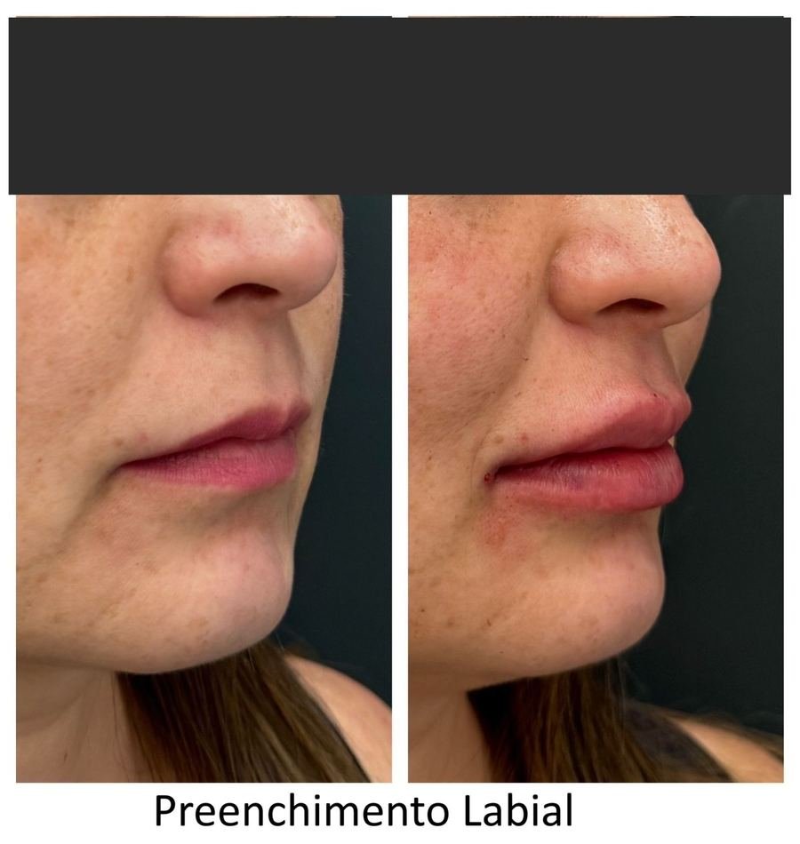 Resultado de tratamento estético — Dra. Priscilla Della Lucia