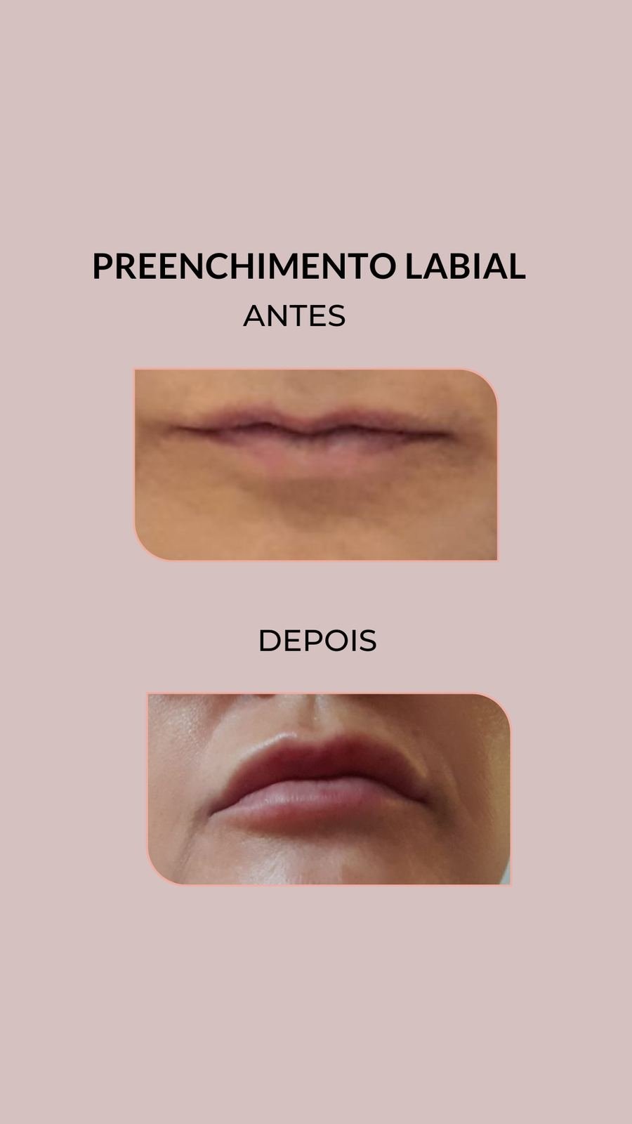 Resultado de tratamento estético — Dra. Priscilla Della Lucia