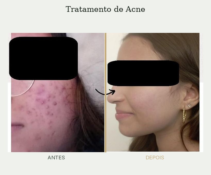 Resultado de tratamento de acne — Dra. Priscilla Della Lucia