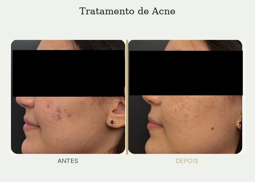 Resultado de tratamento de acne — Dra. Priscilla Della Lucia