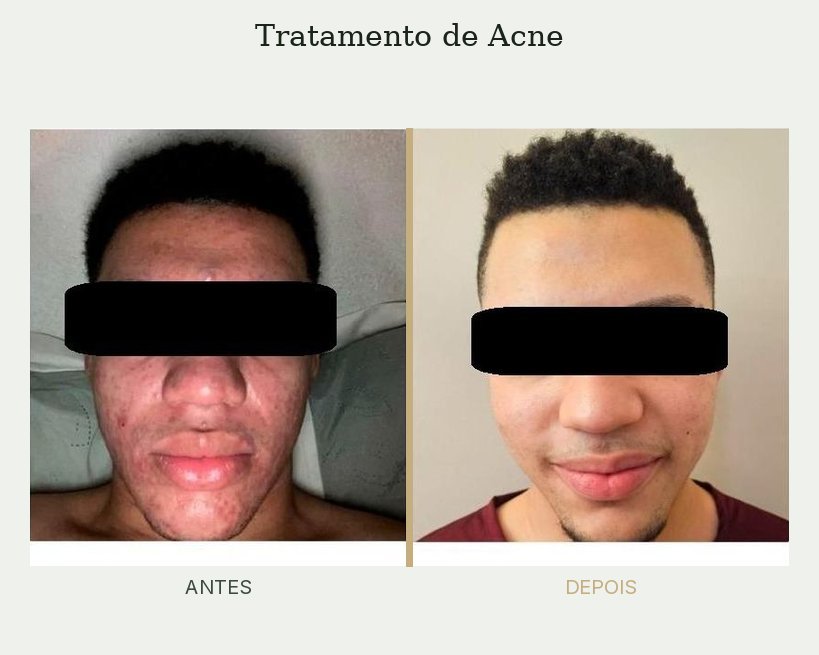 Resultado de tratamento de acne — Dra. Priscilla Della Lucia