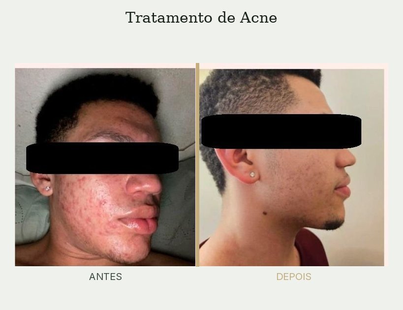 Resultado de tratamento de acne — Dra. Priscilla Della Lucia