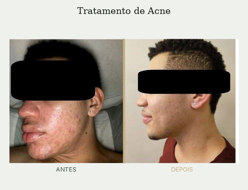 Resultado de tratamento de acne — Dra. Priscilla Della Lucia