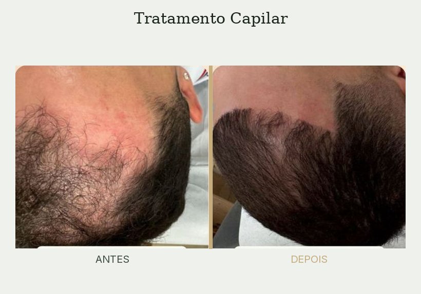 Resultado de tratamento de tricologia — Dra. Priscilla Della Lucia