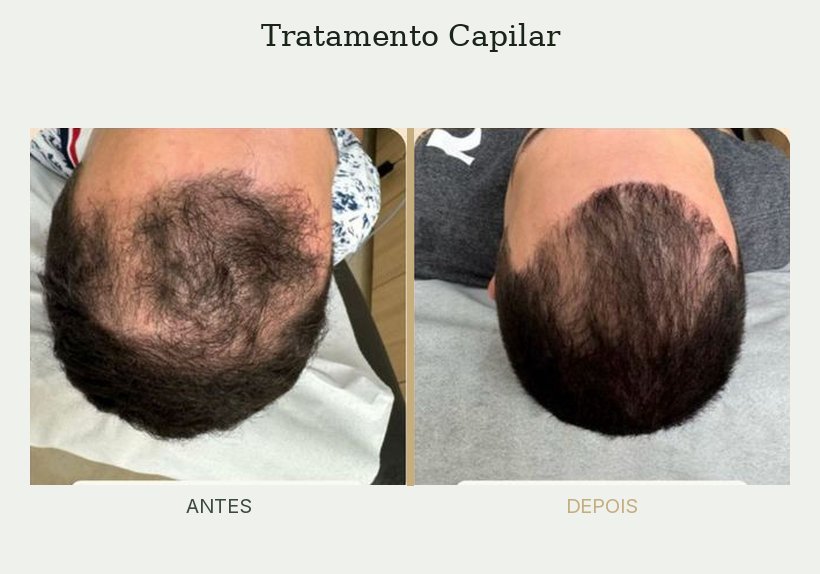 Resultado de tratamento de tricologia — Dra. Priscilla Della Lucia