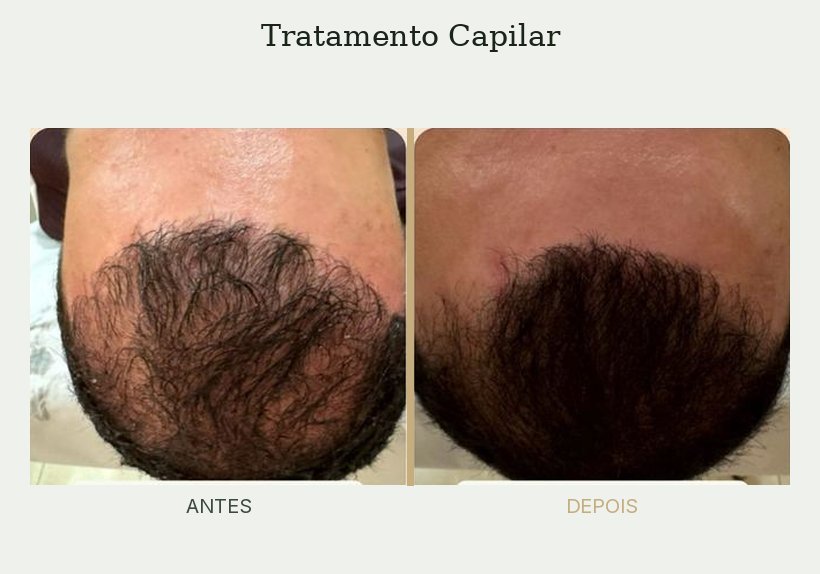 Resultado de tratamento de tricologia — Dra. Priscilla Della Lucia
