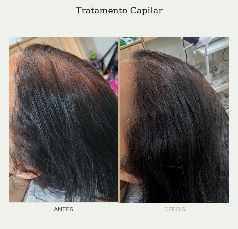 Resultado de tratamento de tricologia — Dra. Priscilla Della Lucia