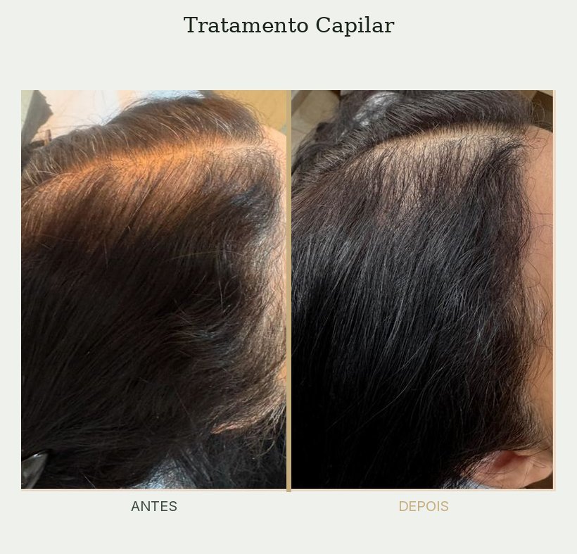Resultado de tratamento de tricologia — Dra. Priscilla Della Lucia