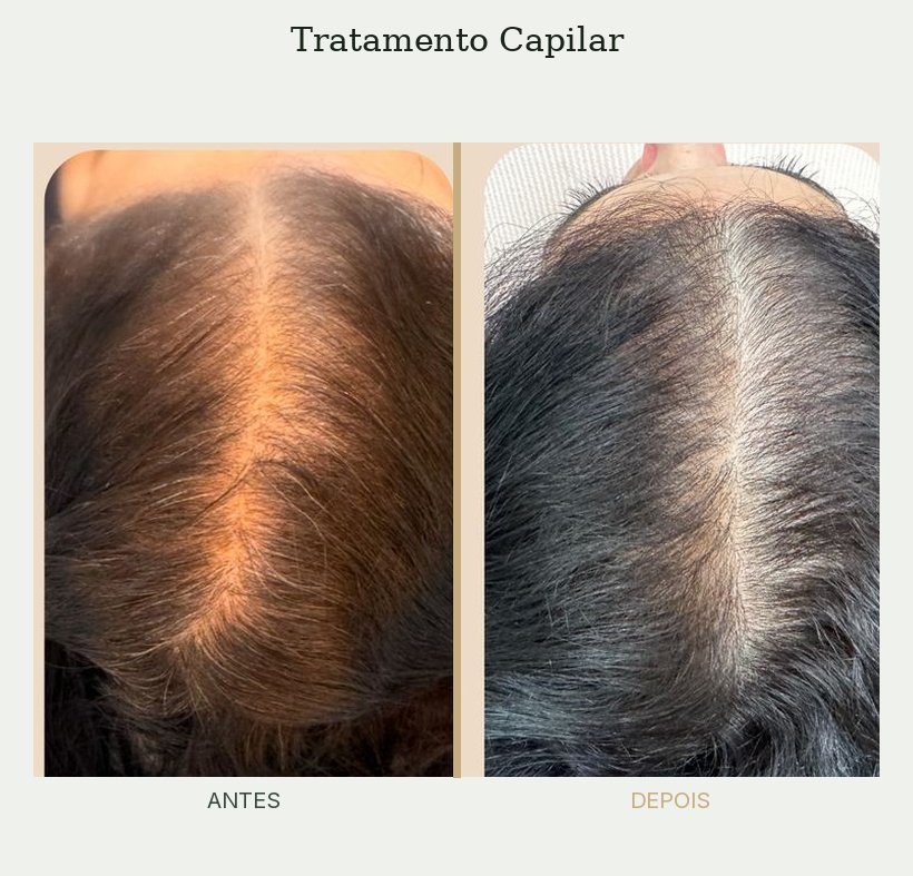 Resultado de tratamento de tricologia — Dra. Priscilla Della Lucia