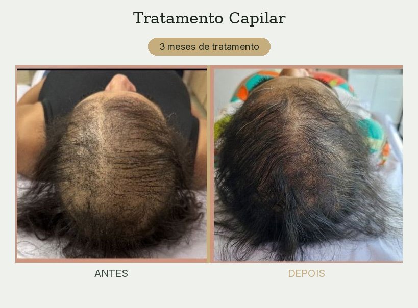 Resultado de tratamento de tricologia — Dra. Priscilla Della Lucia