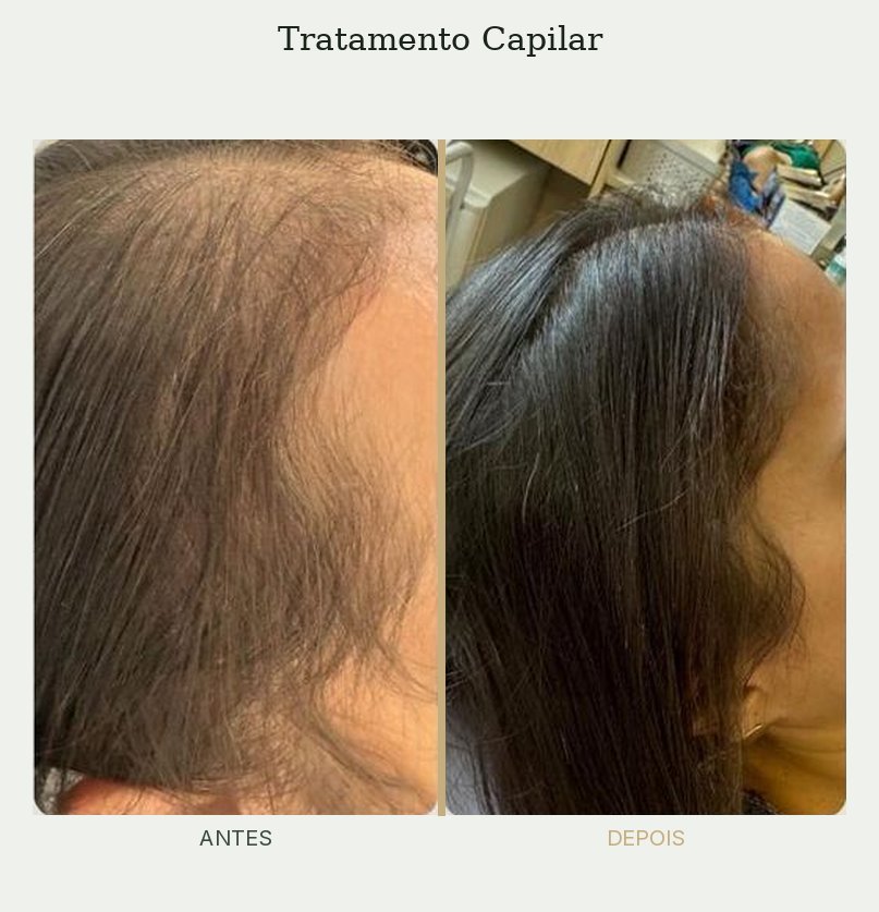 Resultado de tratamento de tricologia — Dra. Priscilla Della Lucia