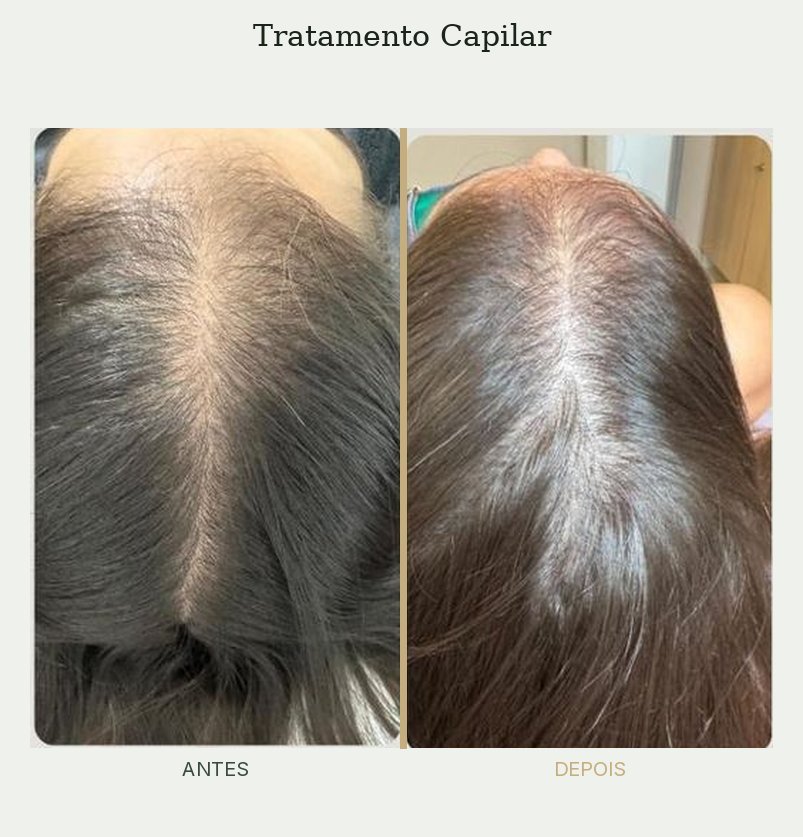 Resultado de tratamento de tricologia — Dra. Priscilla Della Lucia