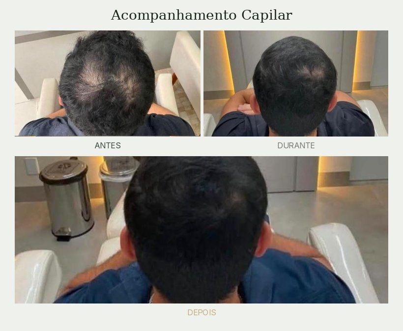 Resultado de tratamento de tricologia — Dra. Priscilla Della Lucia